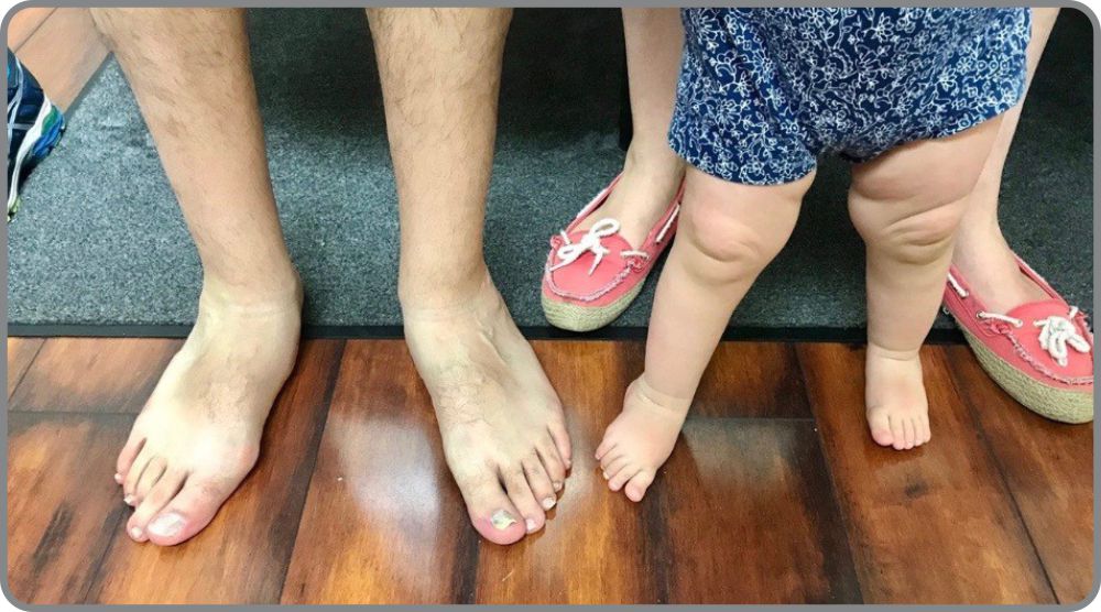 How to Treat Flat Feet at Any Age